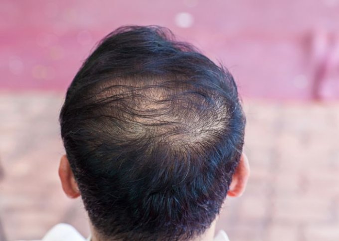 Mężczyzna podczas leczenie wypadania włosów
